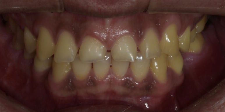 치간이개라미네이트, 벌어진 앞니 개선한 최신사례 관련 이미지 1