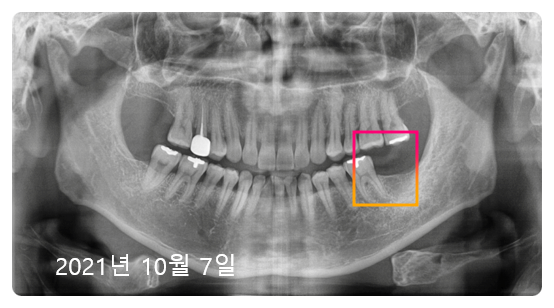 압구정 임플란트? 광고글 보다가 지친 분들만 <필독> 관련 이미지 5