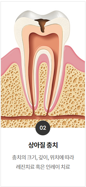 세라믹인레이가격만 보고 치과 결정하지 마세요 관련 이미지 1