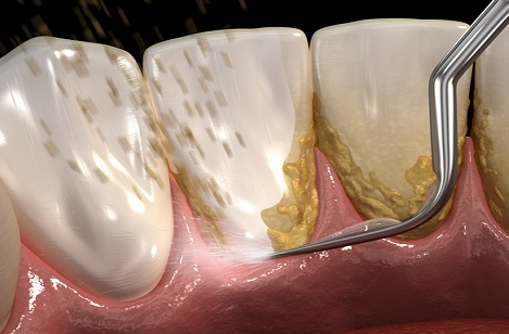 삼성역 스케일링 치과, 아무곳에서나 받으시면? 관련 이미지 4