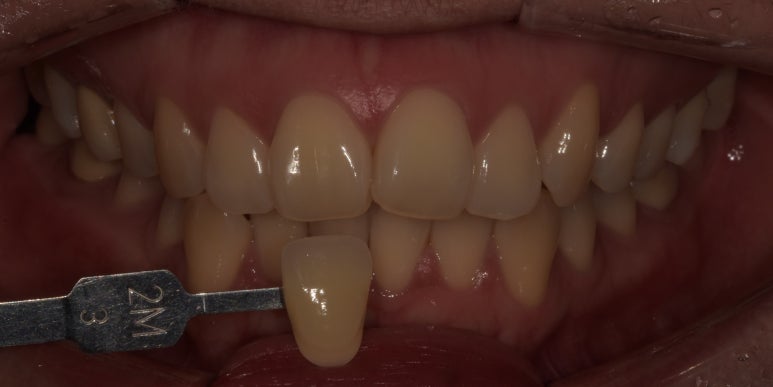 치과치아미백? 연예인처럼 새하얀 치아 못 만듭니다. 관련 이미지 4