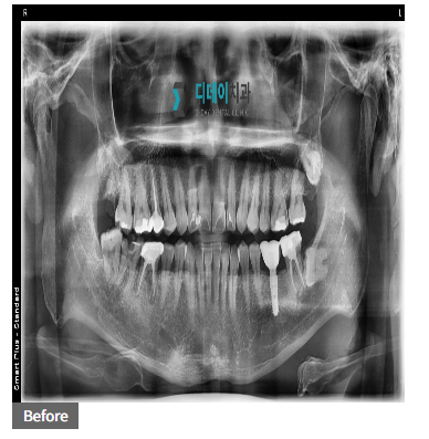 원데이임플란트? 결국 중요한 것은 XX 입니다 관련 이미지 1