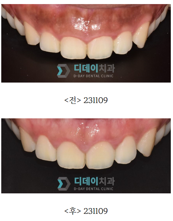 연예인 잇몸성형 방법과 비용은? 관련 이미지 3