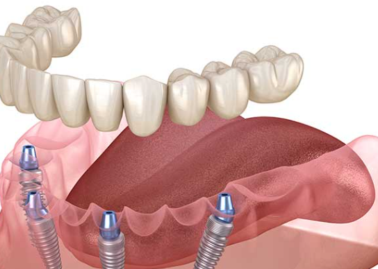 개포동치과, 임플란트 평생 쓰고싶다면 2가지만 확인하세요 관련 이미지 3