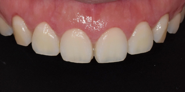 잇몸절제? 절개없이 레이저로 잇몸성형한 후기 관련 이미지 5