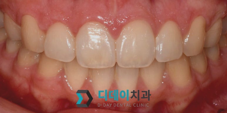 웃을 때 잇몸이 많이 보인다면, 몰라서 못하는 이것 관련 이미지 6