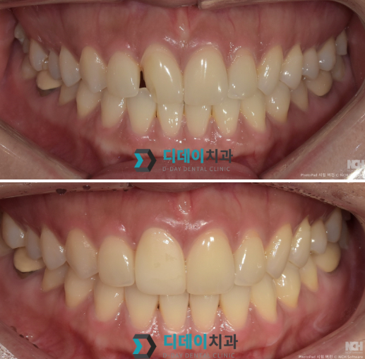 언주역라미네이트 잘하는 치과 특징 3가지 원장 작성 관련 이미지 2