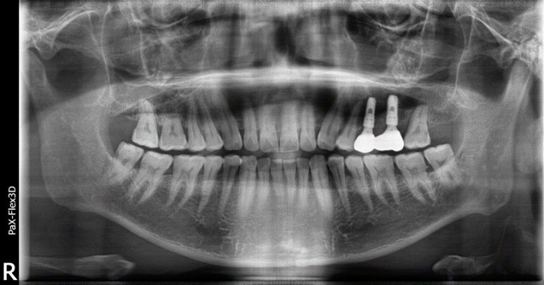 어금니 발치후 임플란트 기간? 식립 시기 모르면 후회합니다 관련 이미지 9