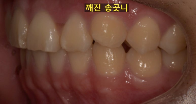 앞니깨짐, 레진? 크라운? 어떻게 치료할 수 있을까요? 관련 이미지 5