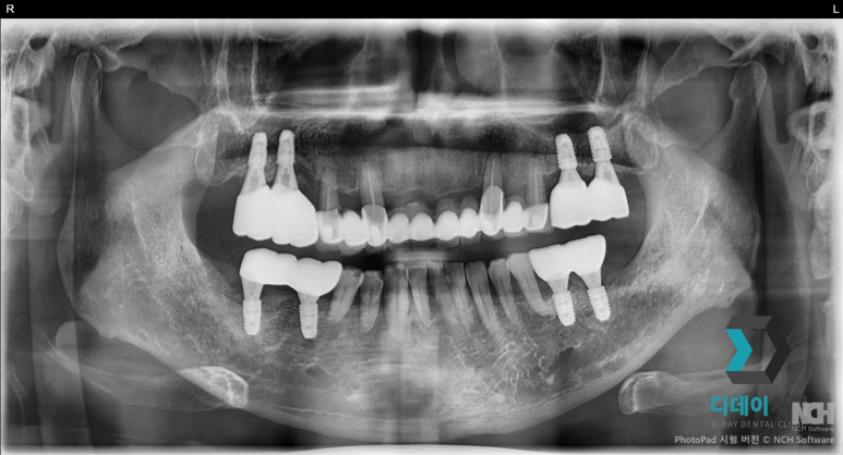 치주염치료비용보다 관련 이미지 9