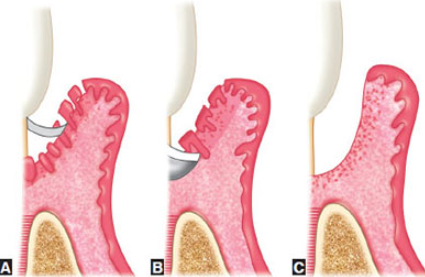 Curettage, for Gum Health image 4