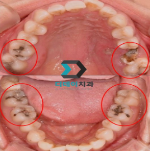 Why Does Acute Pulpitis Occur? The Answer Is Obvious. image 2