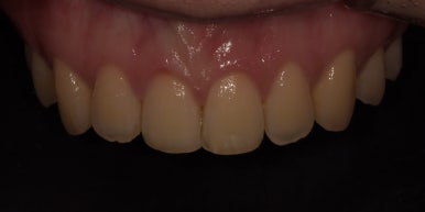 치아다듬기, 만만하게 생각할 치료는 절대 아닙니다. 관련 이미지 5