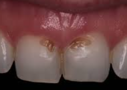 썩은앞니, 빠르게 치료하지 않으면 큰일 납니다 관련 이미지 8