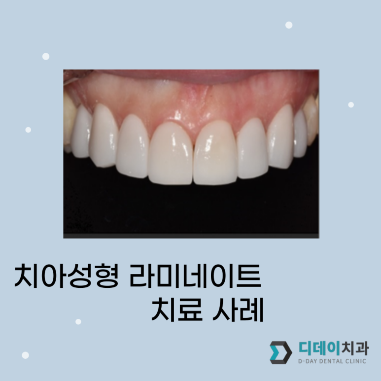강남/선릉 연예인 치아성형? 전문의가 설명드립니다. 관련 이미지 1