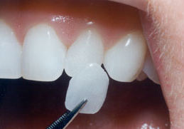 무삭제 라미네이트, 장점과 단점 전문의가 설명드립니다. 관련 이미지 4