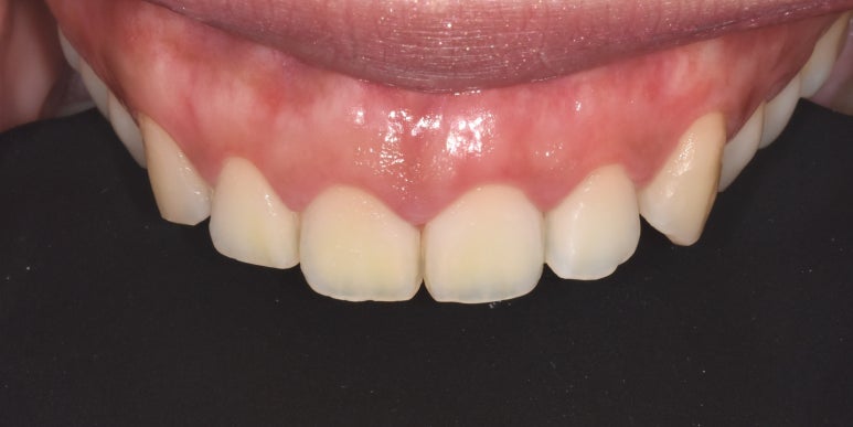 잇몸이까매요... 잇몸착색 치료방법, 사례, 비용 대공개 관련 이미지 3