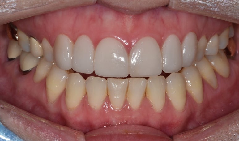 라미네이트통증, 아플까봐 걱정된다면? 확인해보세요 관련 이미지 6