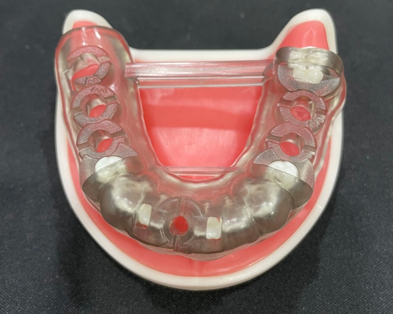 임플란트통증? 아플까봐 무서워서 시술 망설인다면 <필독> 관련 이미지 6