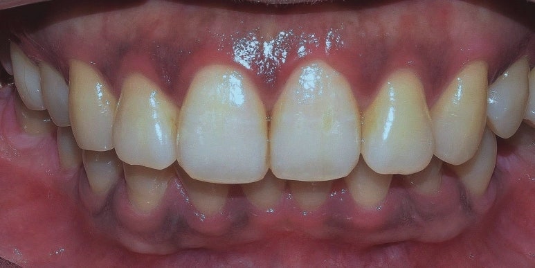 잇몸착색, 변색되어 검은 잇몸 선홍빛으로 되돌리는 방법 관련 이미지 4