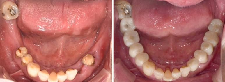 3D임플란트, 네비게이션 비용/통증/과정 총정리 관련 이미지 2