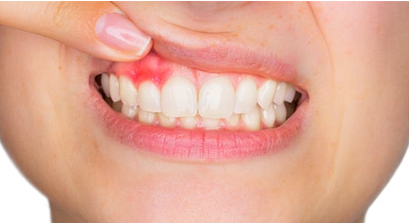 Apgujeong Rodeo Station Dental Clinic: If Your Gums Bleed, Never Ignore It image 2