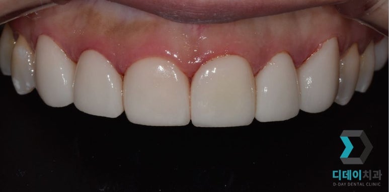 라미네이트후기, 치료사례만 모아 보여드립니다 관련 이미지 12