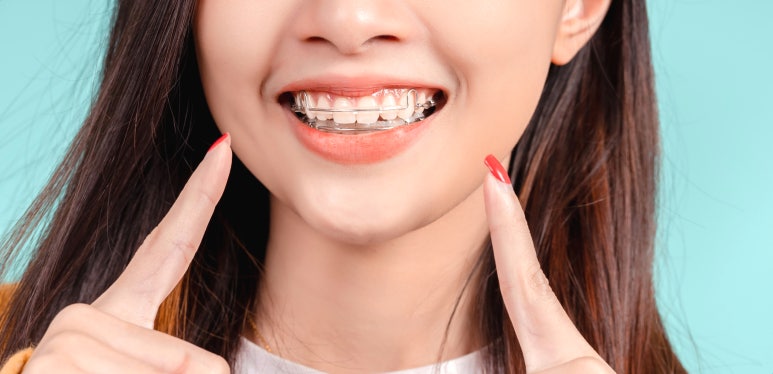 벌어진치아, 교정하지 않고 앞니틈새를 메우는 방법 관련 이미지 2