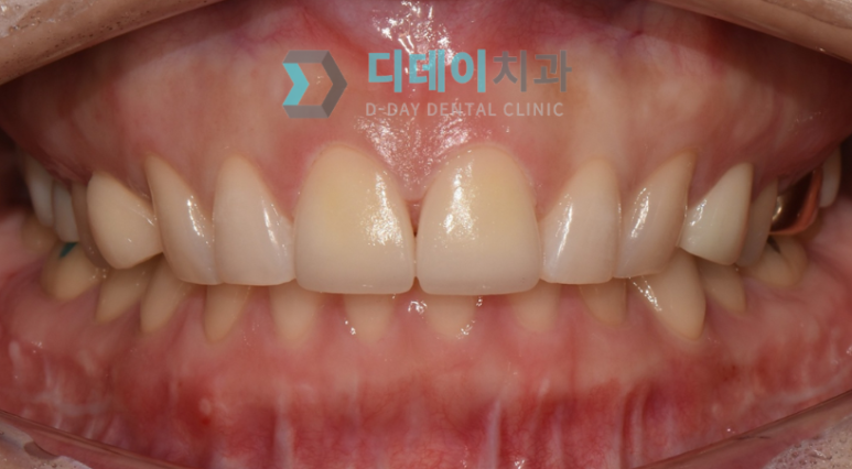 어금니가시려요, 원인별 해결법 의사가 알려드립니다 관련 이미지 6