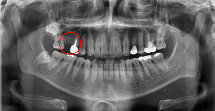 청담역치과? "뼈이식 없이" 임플란트 진행 사례 관련 이미지 1