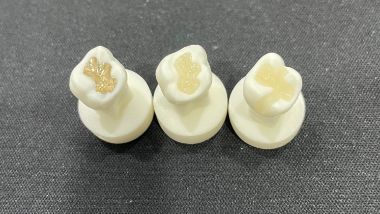 세라믹인레이가격만 보고 치과 결정하지 마세요 관련 이미지 2