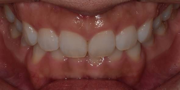 잇몸성형후기, 사례가 없어 고민하셨던 분만 관련 이미지 3