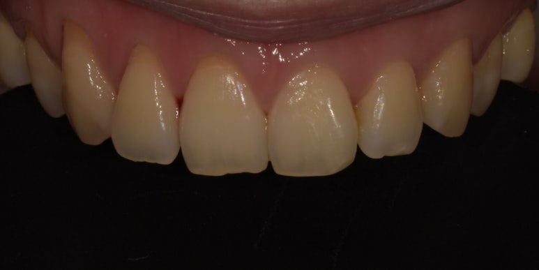 앞니깨짐, 레진? 크라운? 어떻게 치료할 수 있을까요? 관련 이미지 3