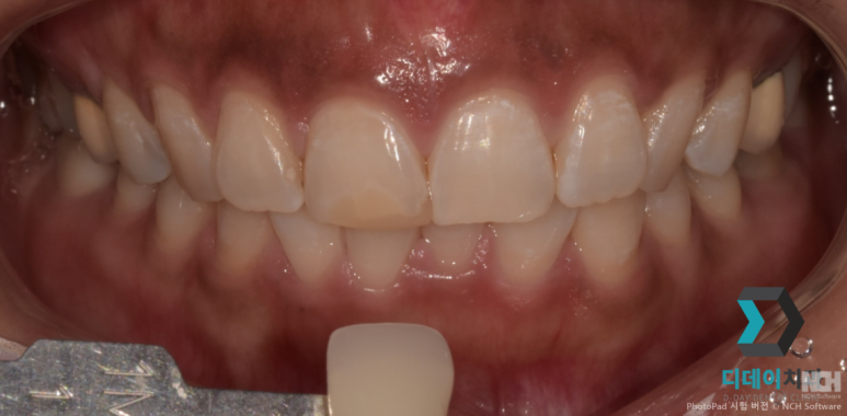 치아미백치료가격만 보고 가면 안되는 이유 2가지 관련 이미지 8