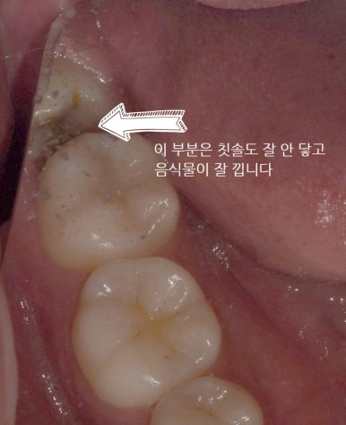 20대임플란트, 겁내지 마세요. 젊을수록 빠르게 회복 가능합니다. 관련 이미지 4