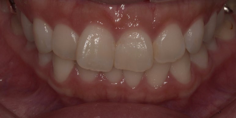 라미네이트 치아삭제? 무삭제만이 정답은 아닙니다. 관련 이미지 4