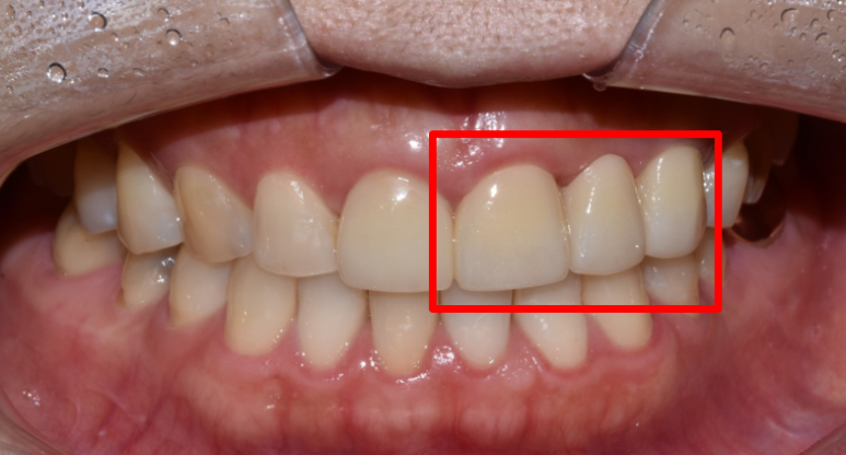 올세라믹지르코니아 차이, 치료사례 궁금하신 분만 관련 이미지 8