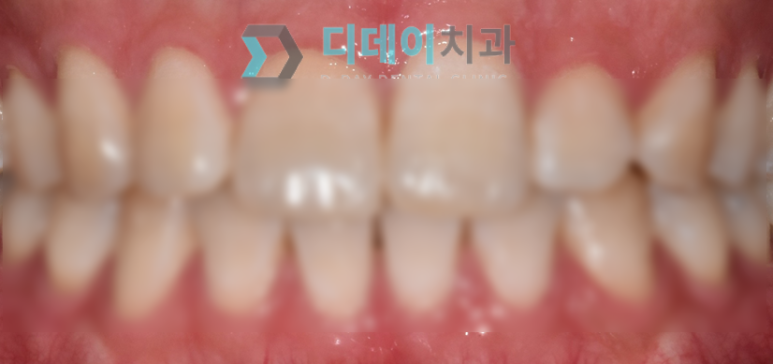 대치동/선릉역 치아미백? 시술 전 필독해야 할 글 관련 이미지 2