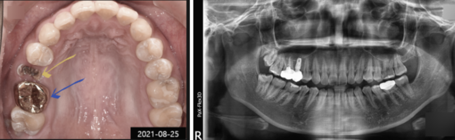 크라운을 임플란트로 교체한 이유 <치료사례> 관련 이미지 1