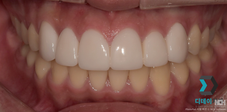 치아미백 라미네이트 잘하는 곳 찾는 2가지 기준 관련 이미지 7