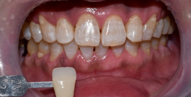 승무원 치아미백, 그 비결이 궁금하다면? 관련 이미지 2