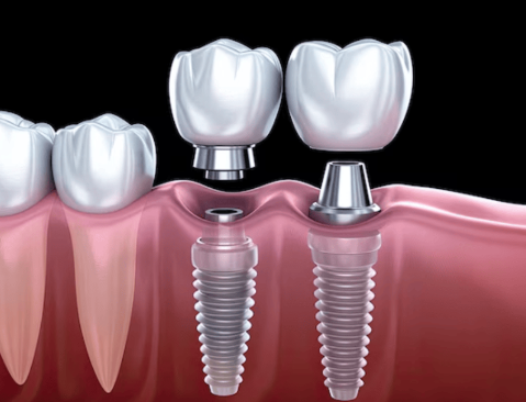 개포동치과, 임플란트 평생 쓰고싶다면 2가지만 확인하세요 관련 이미지 2