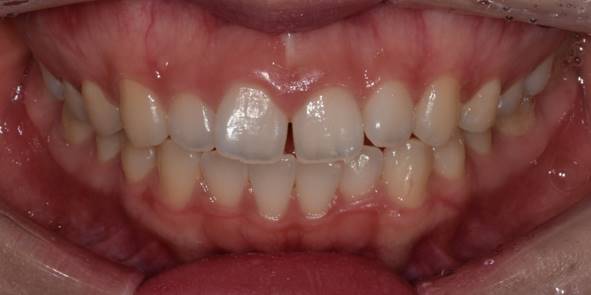 잇몸성형후기, 사례가 없어 고민하셨던 분만 관련 이미지 9