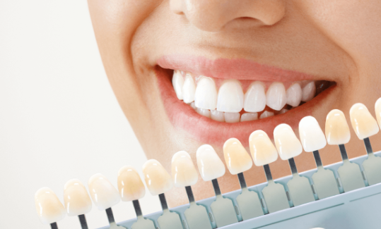 치아 화이트닝, 이번에는 황니 탈출 가능할까? 관련 이미지 3