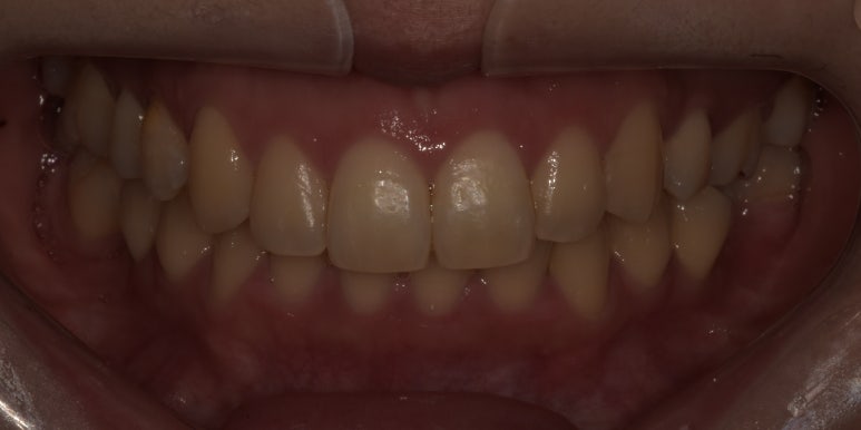 앞니성형? 라미네이트 없이 치아성형하는 방법 관련 이미지 6