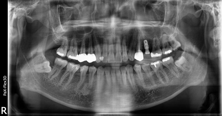 발치즉시임플란트, 아무나 다 되는건 아닙니다. 관련 이미지 4