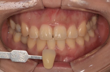 웨딩촬영치아미백? 자신있게, 환하게 웃을 수 있는 꿀팁 관련 이미지 5