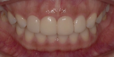 교정? 라미네이트? 앞니배열 바꾸려면 뭐가 더 좋을까? 관련 이미지 7