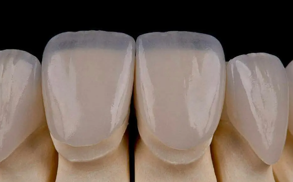 라미네이트 실패원인, 일상생활에서 주의할 2가지 관련 이미지 5