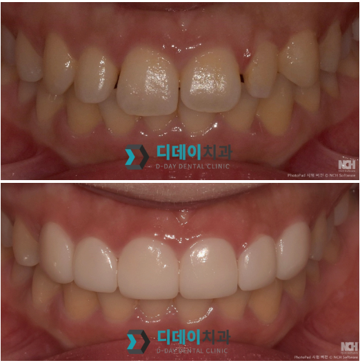 한티역치과, 라미네이트 잘하는 곳 찾기 힘들죠? 의사가 고르는 기준 공개 관련 이미지 4